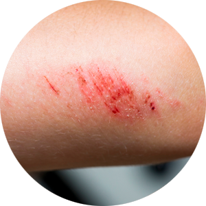 Pierwsza pomoc w urazach tkanki skórnej